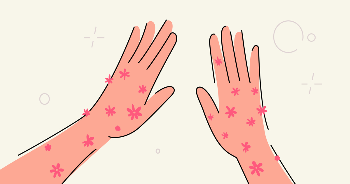 Eczema on Hands 5 Proven Ways to Beat It